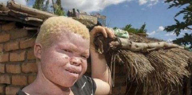 非洲"白人":血液被称作"液体黄金",警察24小时保护不离身