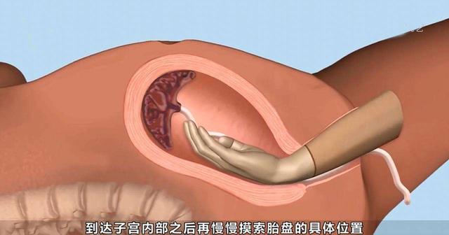 产妇生完孩子半小时,医生再次伸手进去,产妇大怒却被回怼为你好