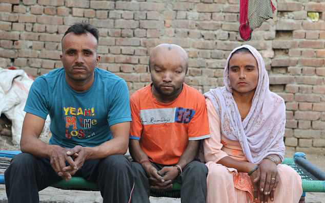 21岁印度男子患怪病,头部异常的巨大,如同"外星人"