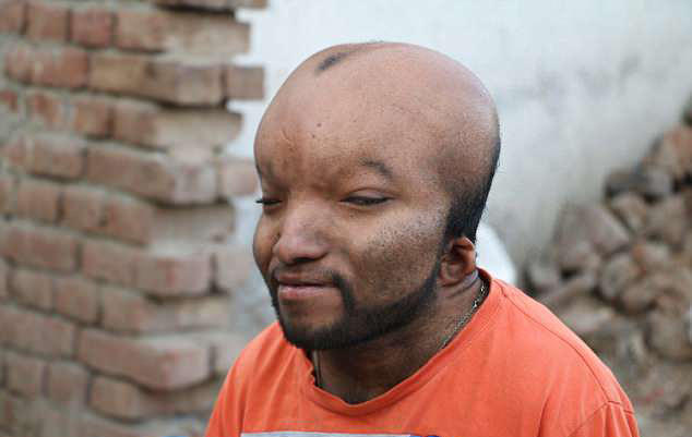 21岁印度男子患怪病,头部异常的巨大,如同"外星人"