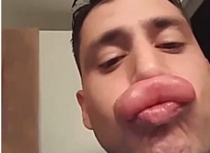 男子嘴巴变成香肠嘴,笑死一堆人,得知原因后有些后怕!