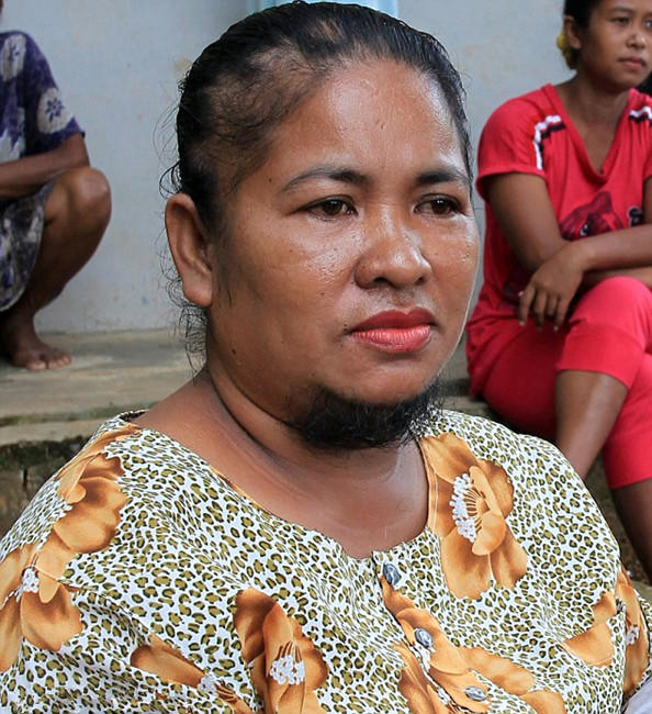 女子长有浓密胡须和胸毛,外形像男人,19年不敢见人