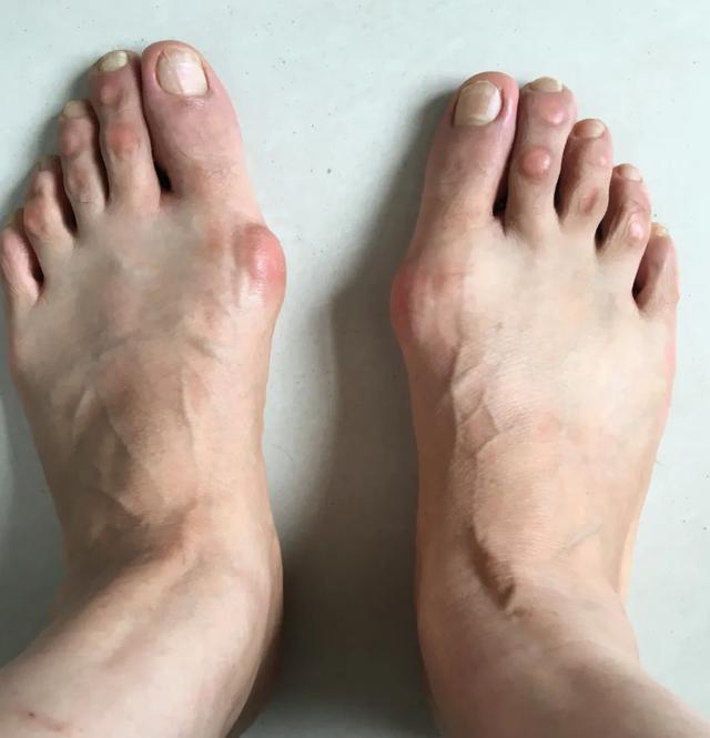 足底行走痛 原来是"大脚骨"惹的祸