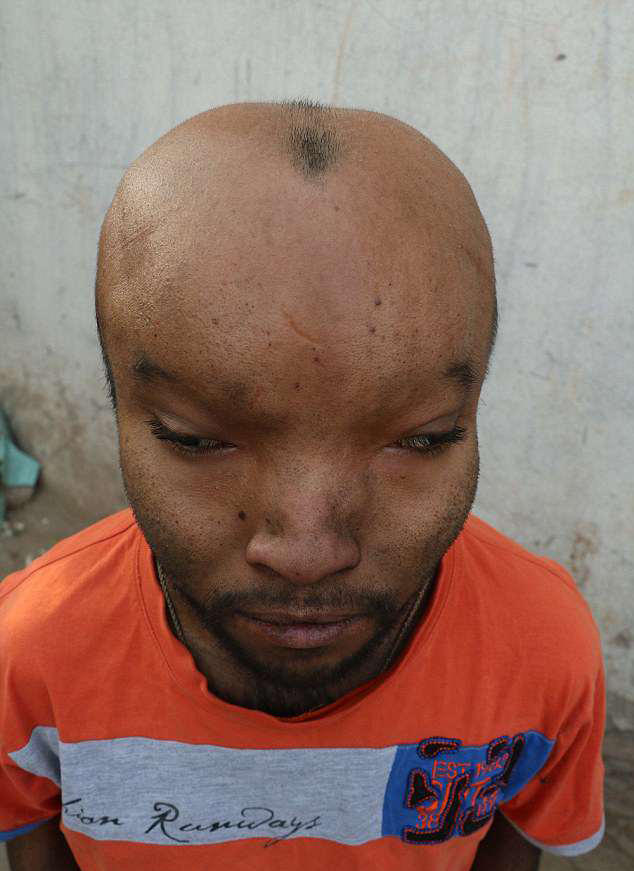 21岁印度男子患怪病,头部异常的巨大,如同"外星人"