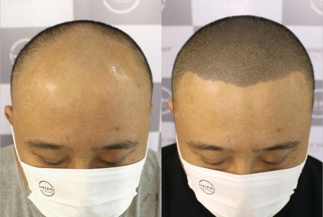 3D纹发效果怎么样？北京纹发哪家好？