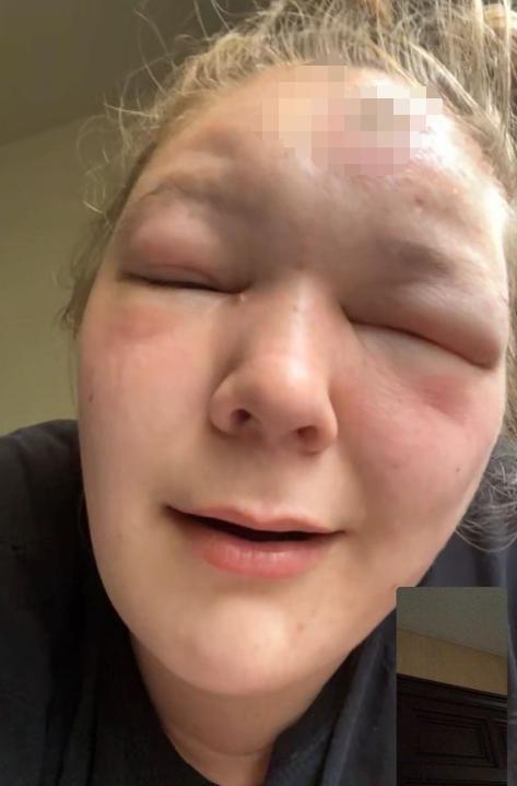 美国女子晒日光浴回家一觉醒来脸部肿胀如猪头头顶还在流脓