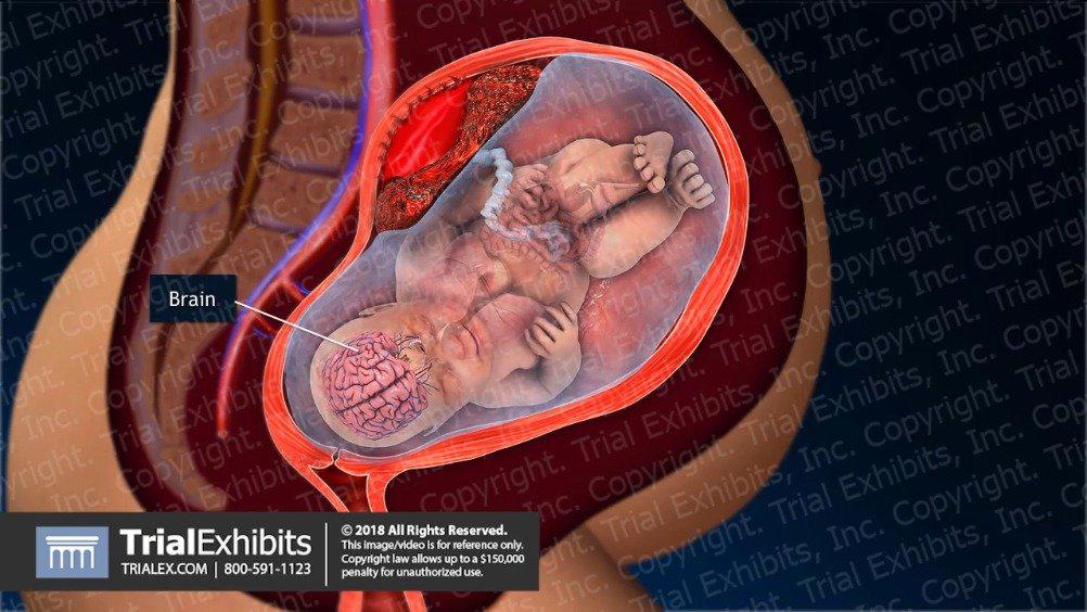 胎盘早剥的病因有哪些?