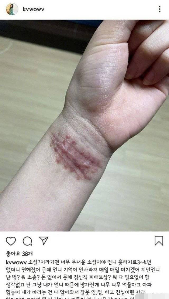 知名女星自爆曾受队友霸凌,晒手腕伤口照,多次割腕痕迹触目惊心