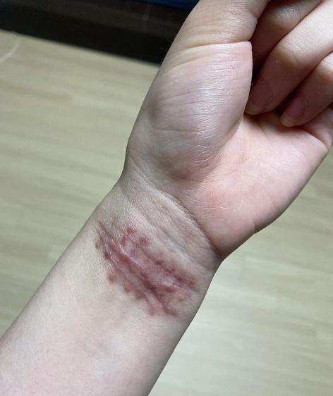 韩国女团前成员晒照,多次割腕痕迹触目惊心,自曝遭受十年霸凌