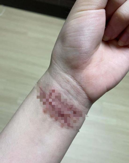 遭受另一名成员霸凌,之后她上传照片,左手手腕处一条条的伤疤触目惊心