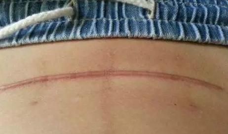 剖腹产疤痕增生会自己消除吗