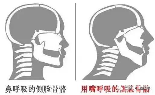 鼻腔的气压平衡,导致鼻腔不能向下扩展,造成腭盖高拱;张口呼吸危害大