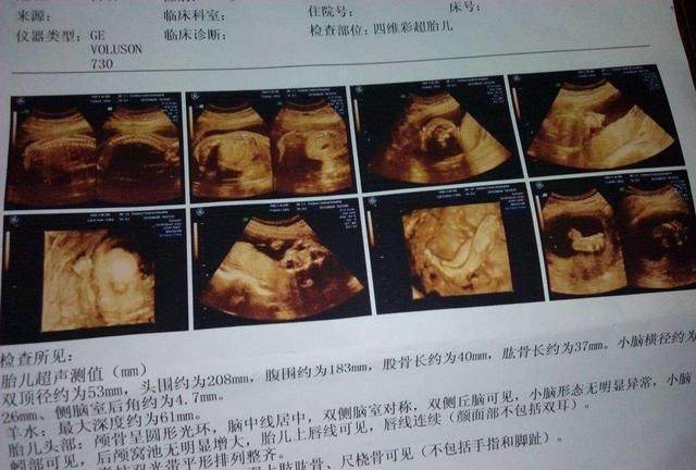 怀孕四周彩超图片图片