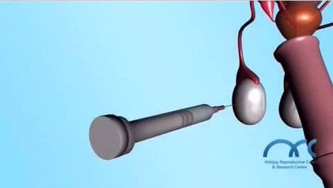 手札君带你秒懂穿刺取精那些事儿 部分无精/子症患者的精/子在