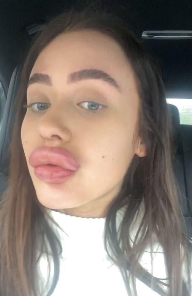 英国21岁空姐做唇部美容,结果嘴肿成香肠,拒接男友电话怕被嫌弃