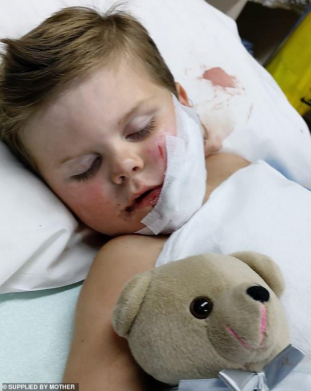 澳大利亚2岁男孩遭狗袭击,脸被咬成两半牙齿外露,主人:一小口而已