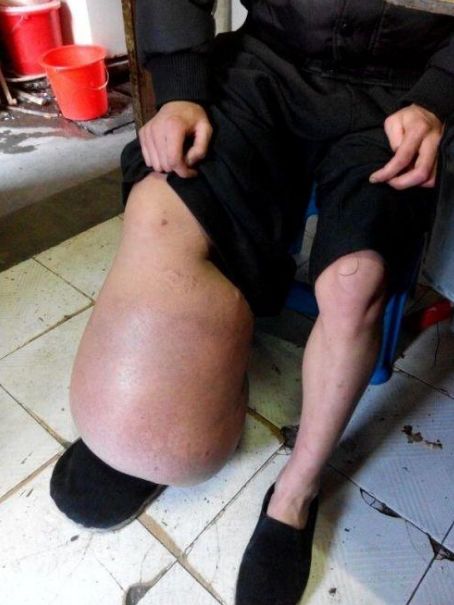 男子一只脚41码一只脚60码,路人看了纷纷表示心疼|皮克|路人|残疾人