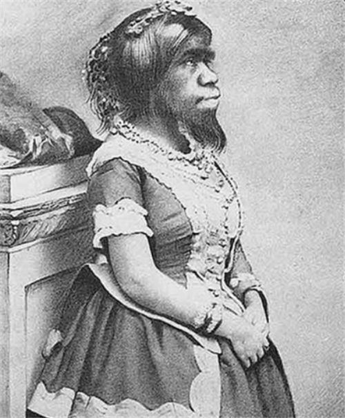 多毛症,因此被当成了怪物,人们要么叫她"毛女",要么是称她"女猿人"