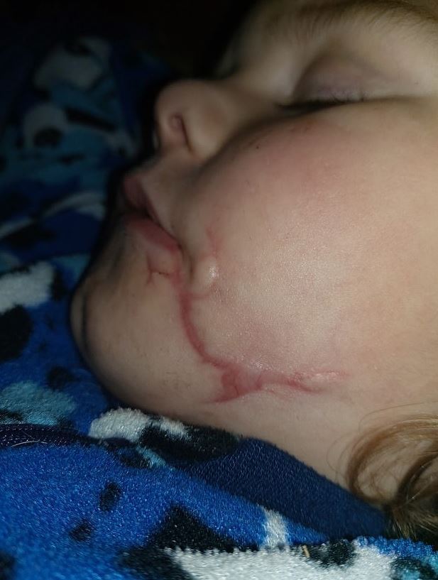 一名2岁男孩的脸被一只狗严重咬伤,牙齿都露出来了.