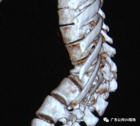 让人担心的是因为蝴蝶椎的病情进展很快容易使神经系统受累和脊髓被