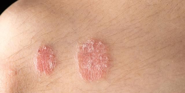 无缘无故患上牛皮癣,会越来越严重吗,银屑病的有效药物有哪些