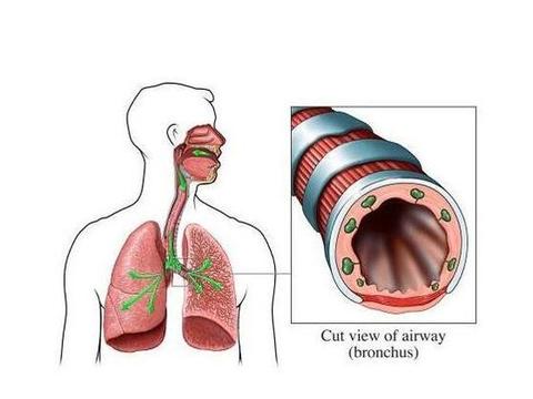 支气管炎的主要特征:1,干咳:嗓子痒,痒了就咳,不痒不咳,也就是说没有