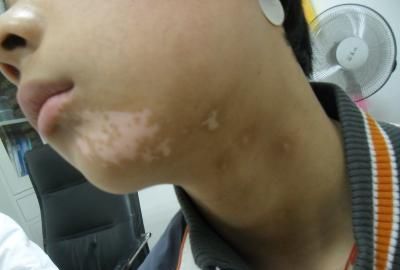 身体缺乏哪些营养素会长白头?哪5种人容易长白发?你是吗