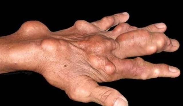 对于那些吃止疼药的人来说,当痛风不再痛的时候,是继续吃药还是停药?