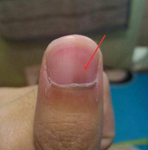 肺病并不是"悄无声息",手上有2种标记,最好查一下肺ct|肺癌|肺部|肺病