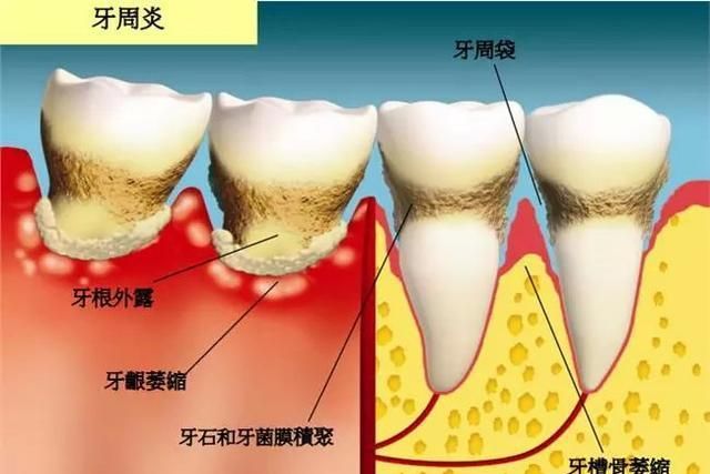 究竟是谁"偷走"了你的牙槽骨骨量,牙齿一颗颗掉
