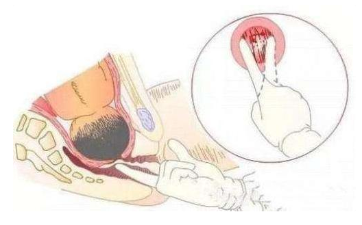 受感染的风险很低,而阴道内检的优点是准确率较高,检查结果更可靠一些