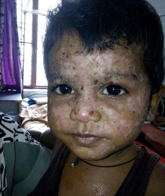 印度爸妈迷信黑魔法女儿脸蛋化脓烂掉带去医治后恢复天使模样