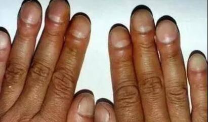 1,手指粗肺病并不是"悄无声息",手上有2种标记,最好查一下肺ct所以