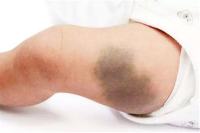 成人身上会有淤青,通常是因为皮肤受到外力撞击后, 毛细血管破裂,血液