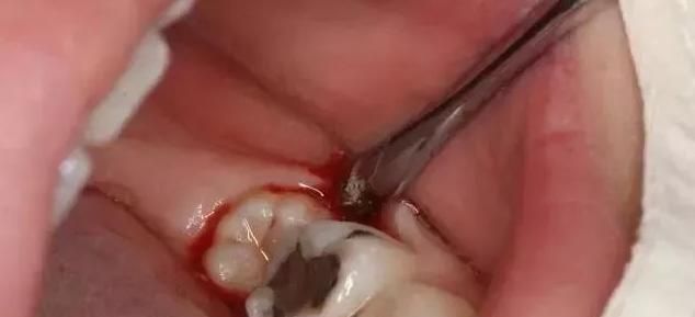 牙",需要一颗颗拔掉,奶奶自责不已:都赖我|双排|乳牙|恒牙_新浪新闻