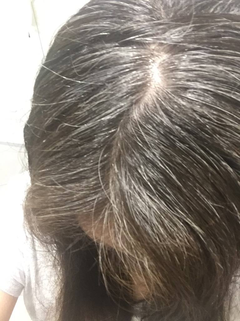 少白头是怎么回事记住三点坚持一到两周就会慢慢改善