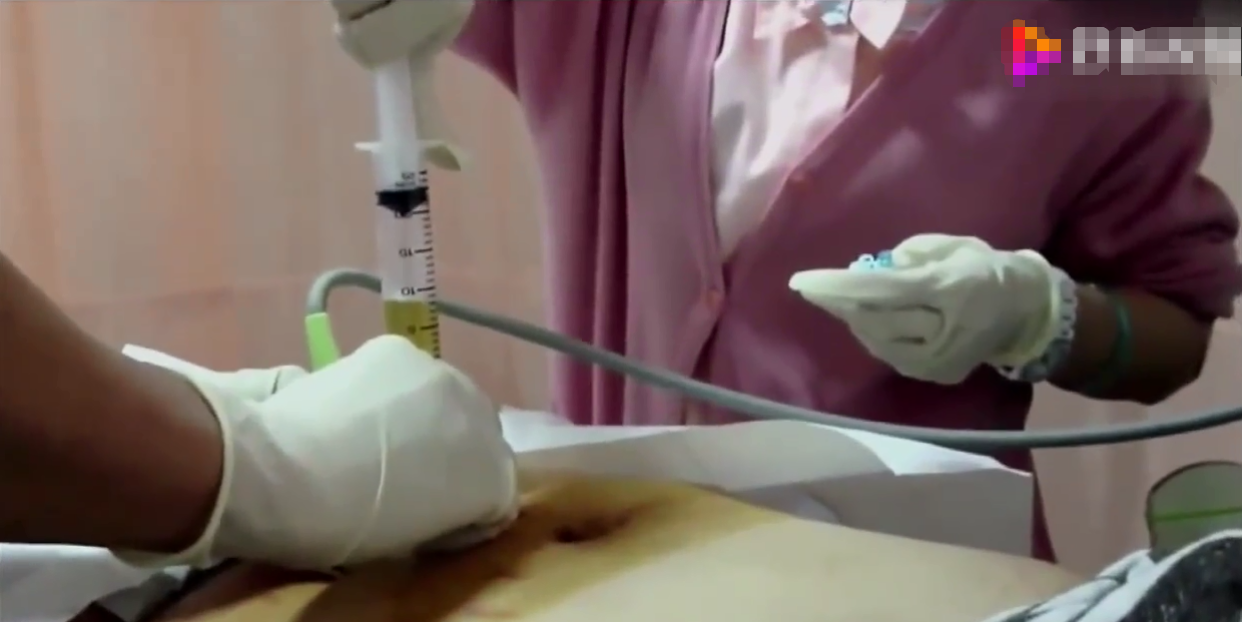 为什么说羊水穿刺是孕妈噩梦哪类孕妇需要测全过程还原