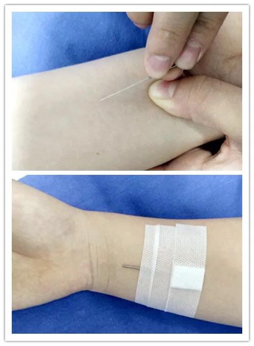 一针下去,痛了多日的颈肩不痛了