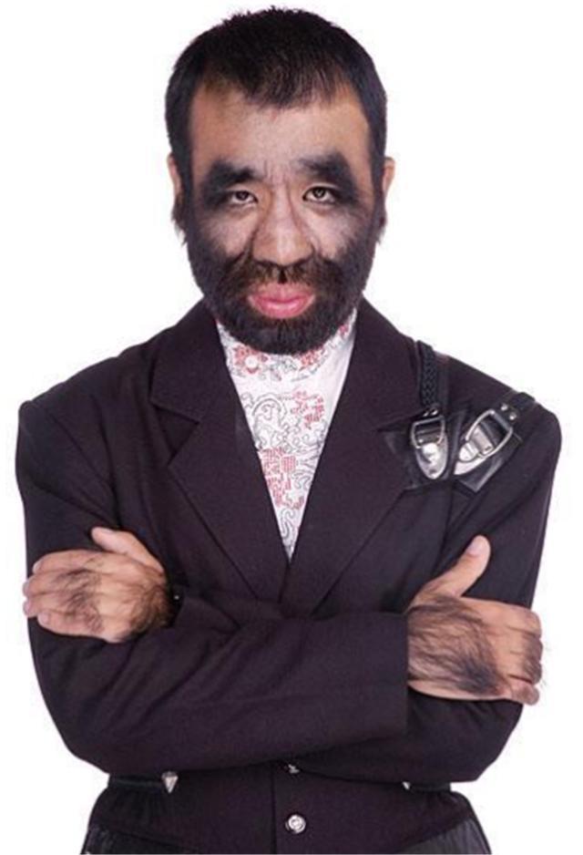 中国第一毛孩出生就被研究身体96覆盖黑毛42岁终遇真爱