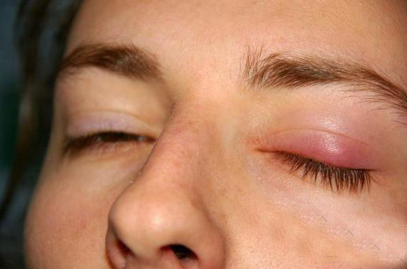 男孩眼皮上长了橘子一样大的痘痘,医生拿起刀划了一下痘痘爆炸了