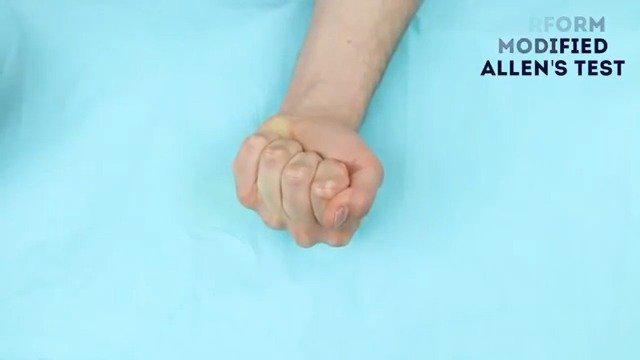 allen test 艾伦试验 受检者握紧拳头