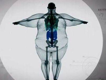 这个体重900斤的男子,在看到自己的x光片之后开始减肥