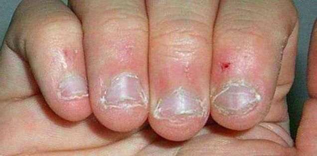 小时候爱啃指甲的娃,长大会怎么样?医生直言:大概是这两种结局