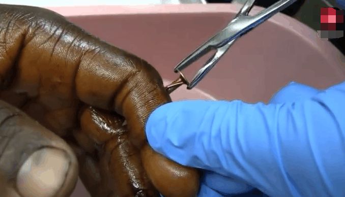            其实扎到的时候不疼,拔了以后才很痛.