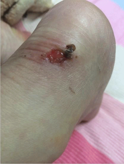 鞋头硌脚不说,穿一天脚就疼到不能走路,尤其是脚后跟不小心磨出水泡别