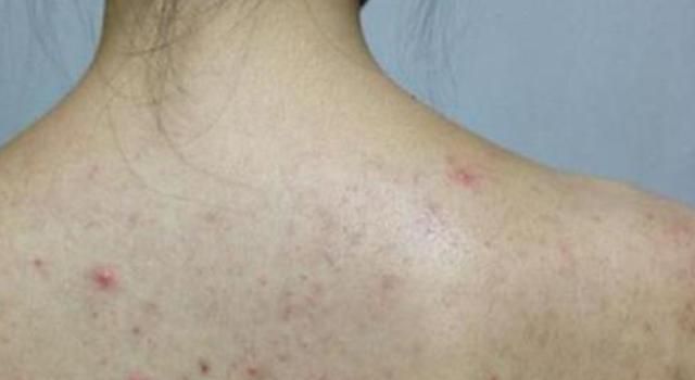 背部突然长小鸡皮肤病(背上皮肤瘙痒 鸡皮突出)