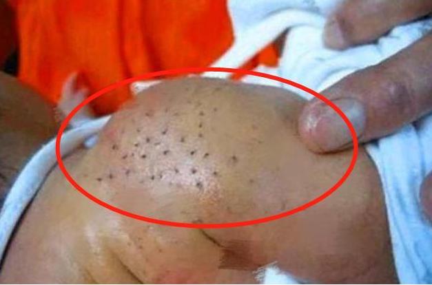 宝宝背后长出"黑刺",宝妈好心悉数拔除,医生怒斥:太无知