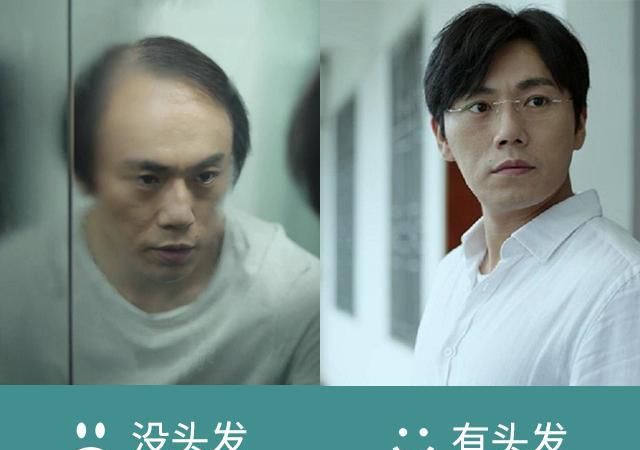 张东升“拍了拍”你的秃头,你的发际线还好吗|脱发|发际线|张东升_新浪新闻