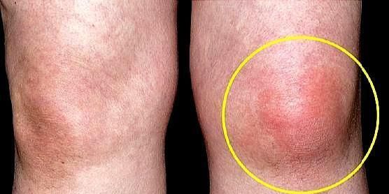 膝关节突然红肿热痛夏季多见于这两种情况该咋办医生告诉您