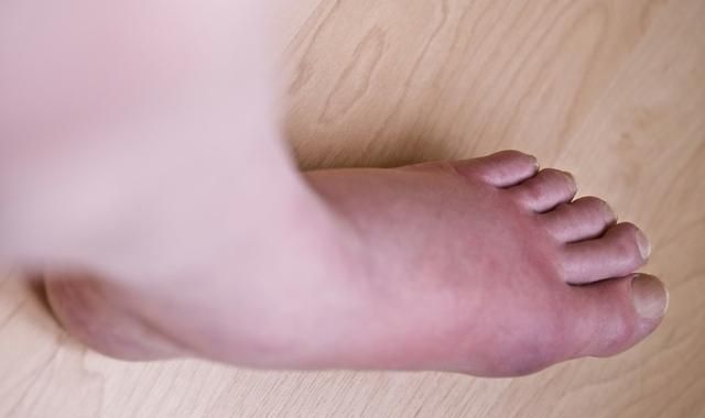 痛风发作关节红肿疼痛,吃了药,为什么不好?三个治疗误区需避免